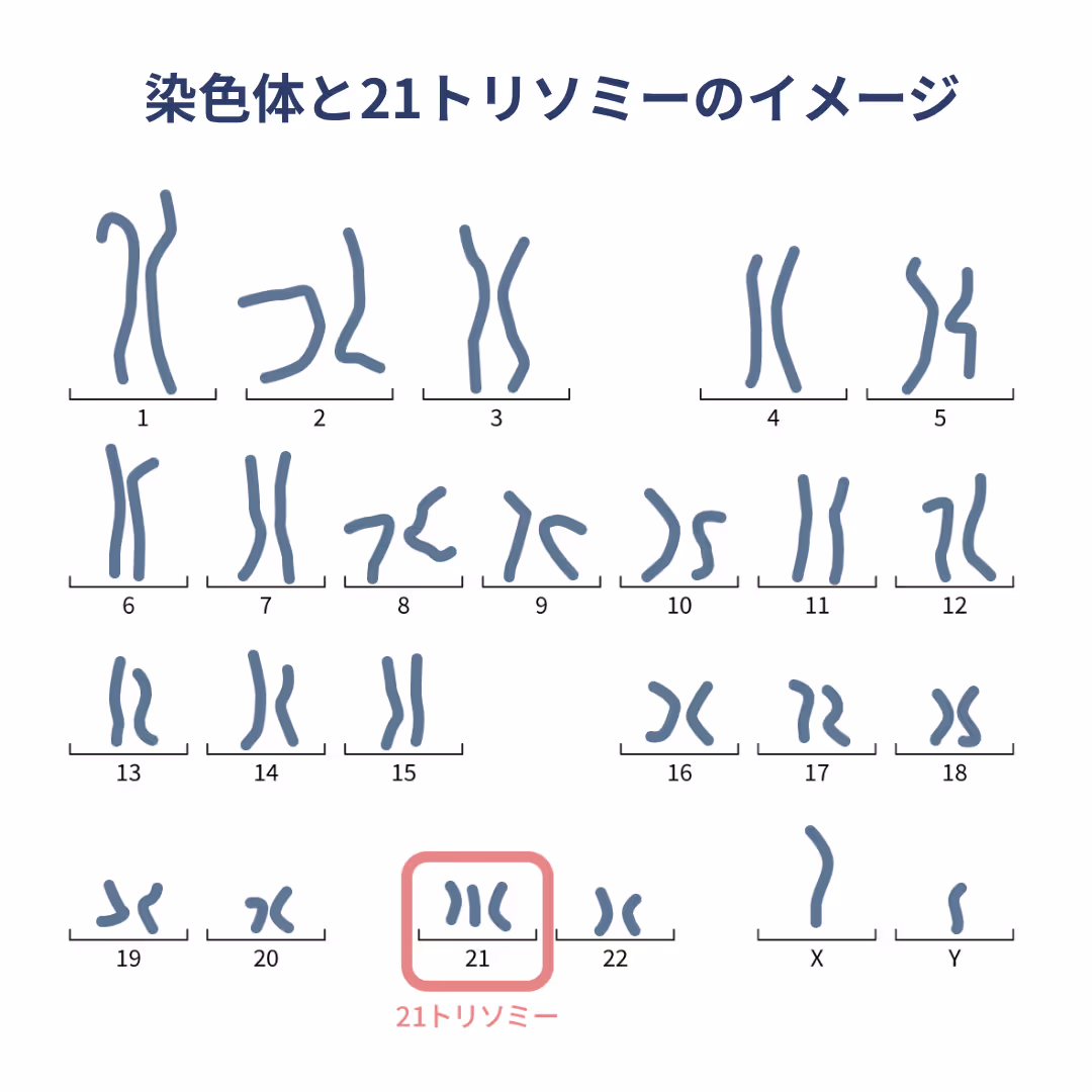 染色体と21トリソミーのイメージ