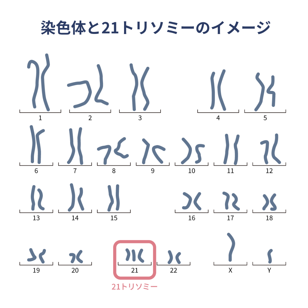 染色体と21トリソミーのイメージ