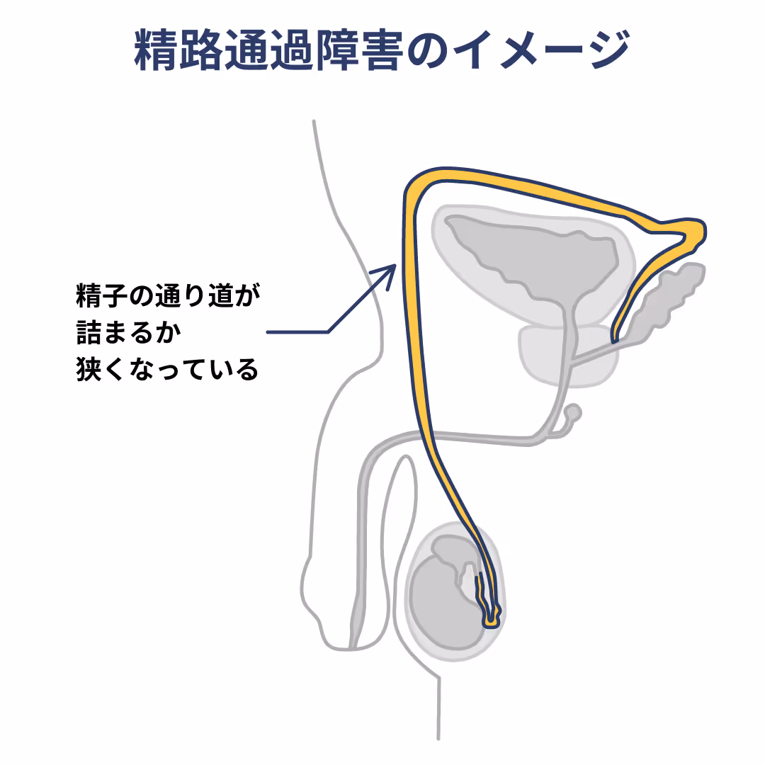 精路通過障害のイメージ