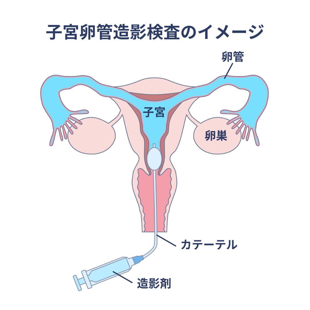 子宮卵管造影検査のイメージ