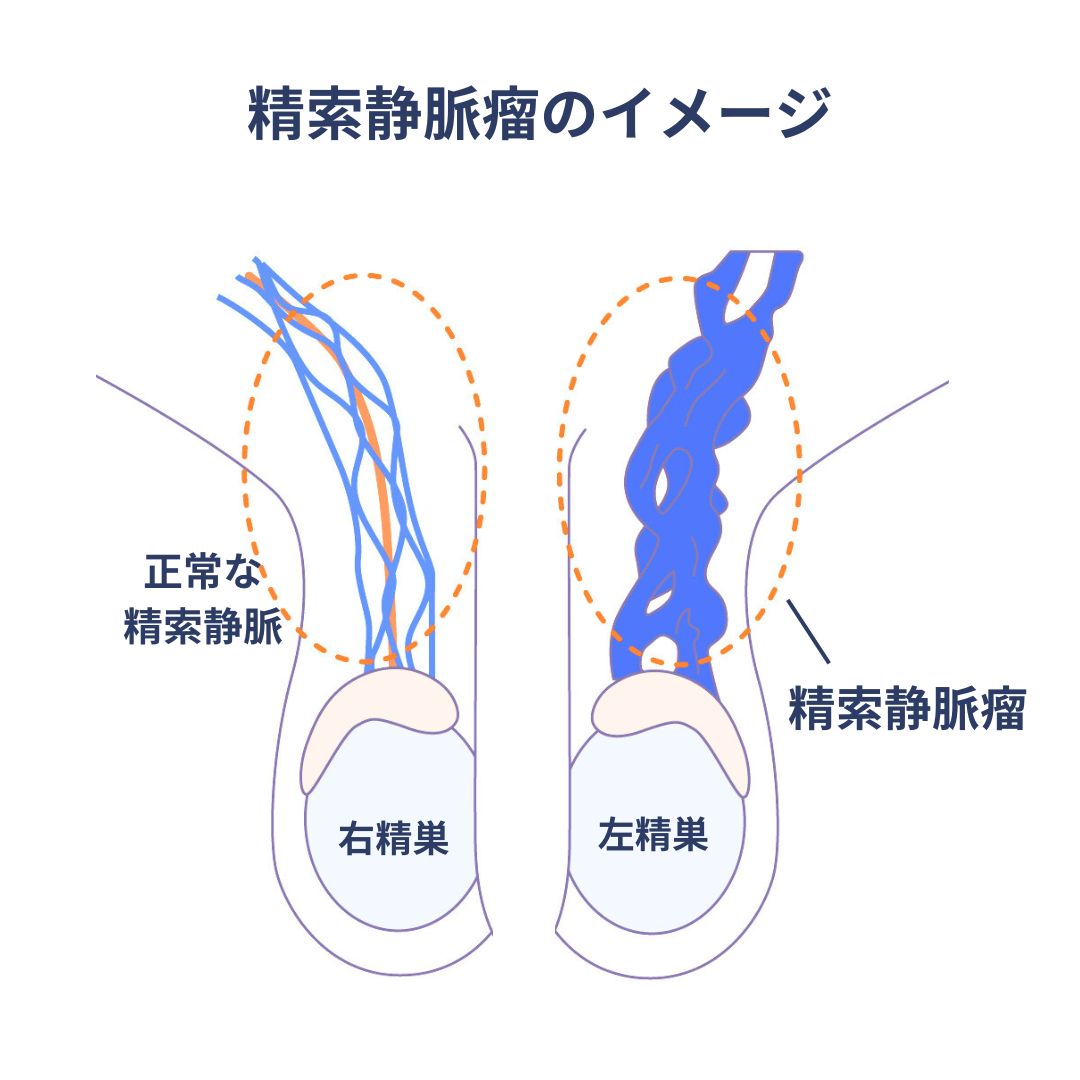 精索静脈瘤のイメージ