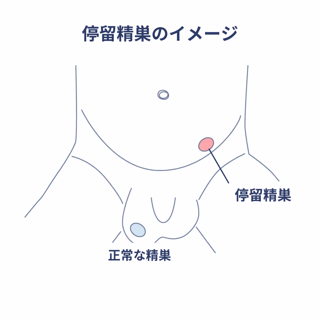 精索静脈瘤のイメージ
