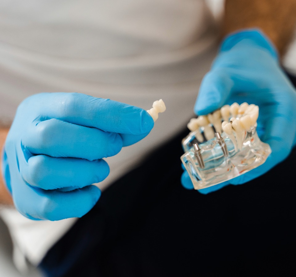 Welche Alternativen gibt es zu Zahnimplantaten?