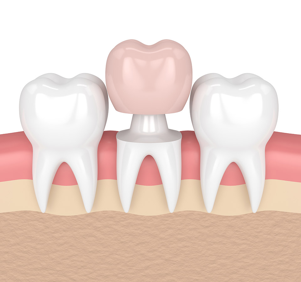 Was ist eine Krone? Zahnarzt Plochingen / Esslingen / Stuttgart