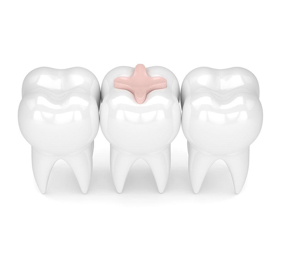Was ist ein Inlay? Zahnarzt Plochingen / Esslingen / Stuttgart