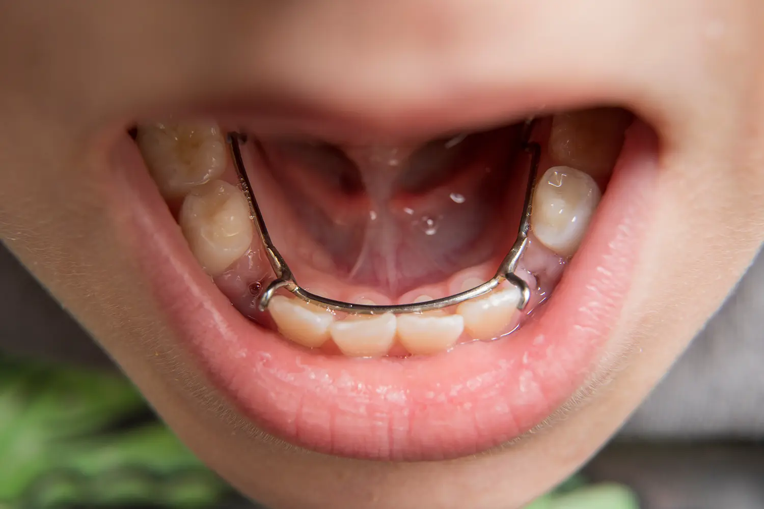 Tongue Tie & Lip Tie Treatment Near Easton, PA - Lesavoy Pediatric Dentistry