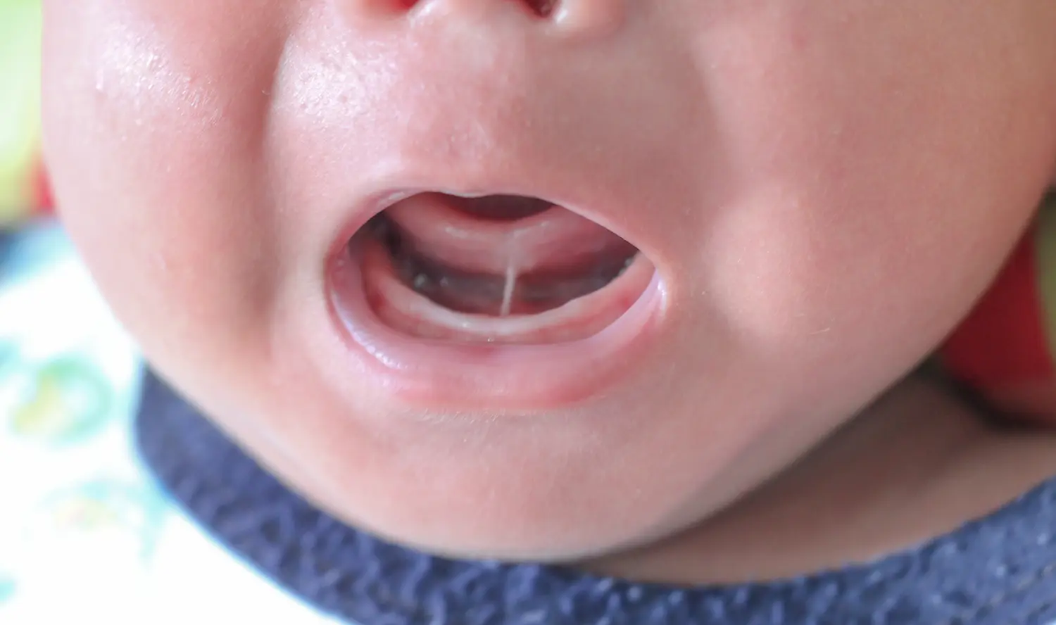 Tongue Tie & Lip Tie Treatment Near Bethlehem, PA - Lesavoy Pediatric Dentistry