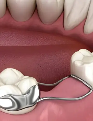 To Prevent Tooth Shifting