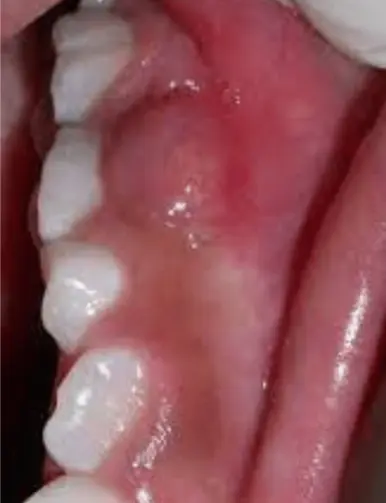 Early Prevention