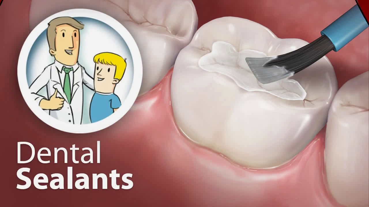 Dental Sealants and Fluoride Treatment