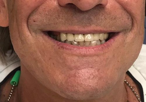 טיפול פה של ספייק