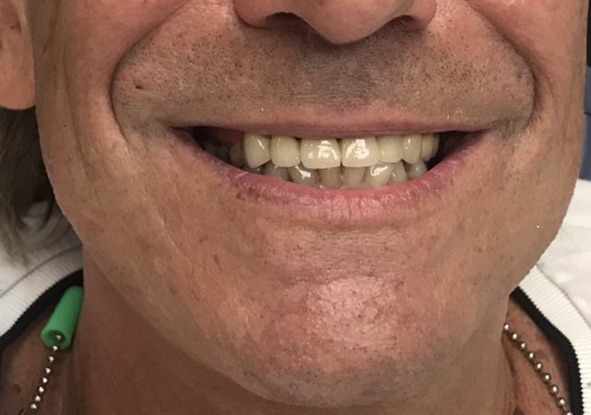 טיפול פה של ספייק