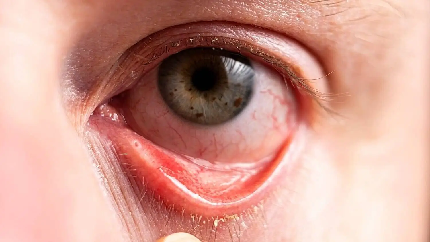 A close up of a person's eye with blepharitis
