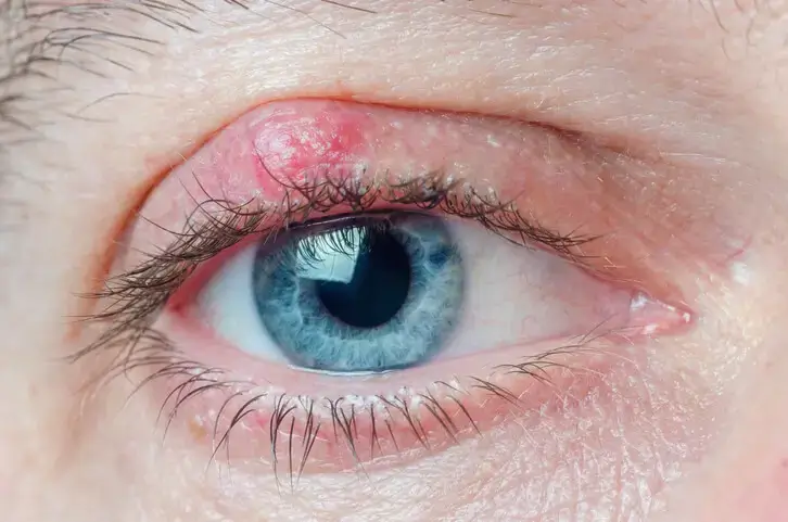 A close up of a blue eye with a chalazia.