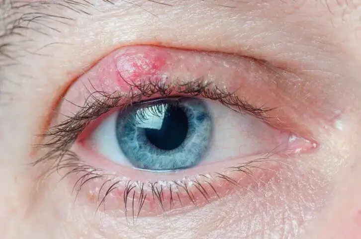 A close up of a blue eye with a chalazia