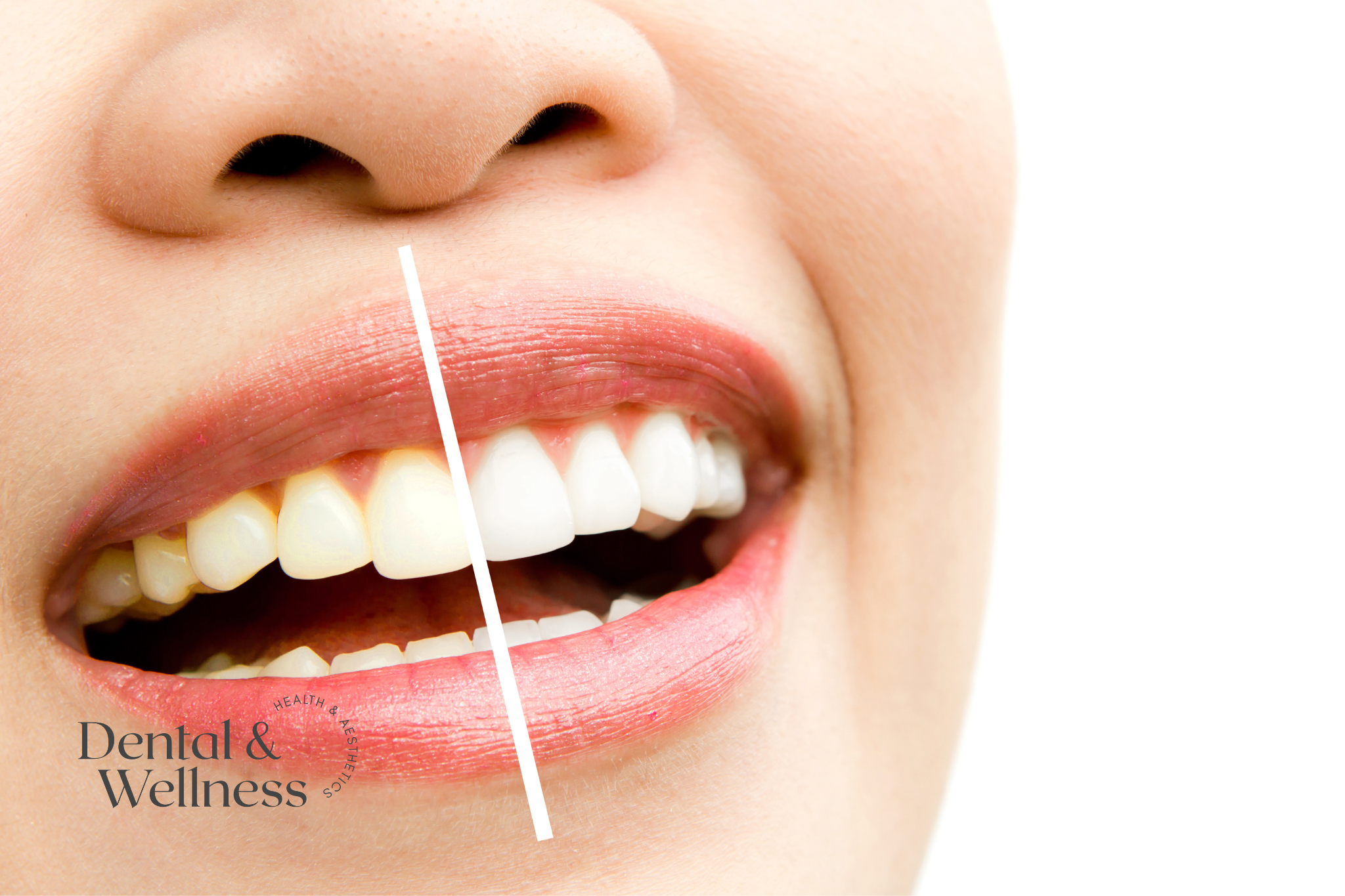 masseter botox jaw pain relief