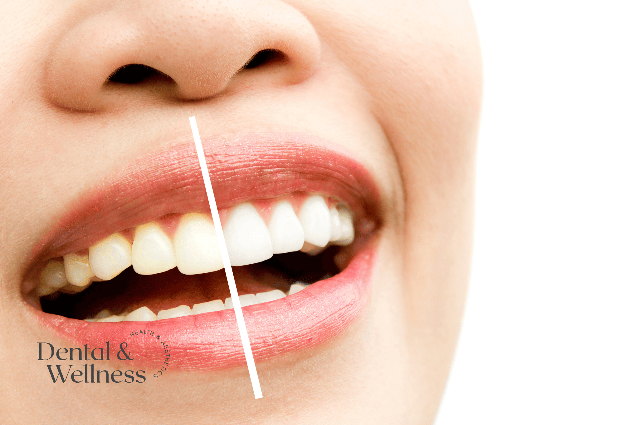 Teeth before and after professional whitening