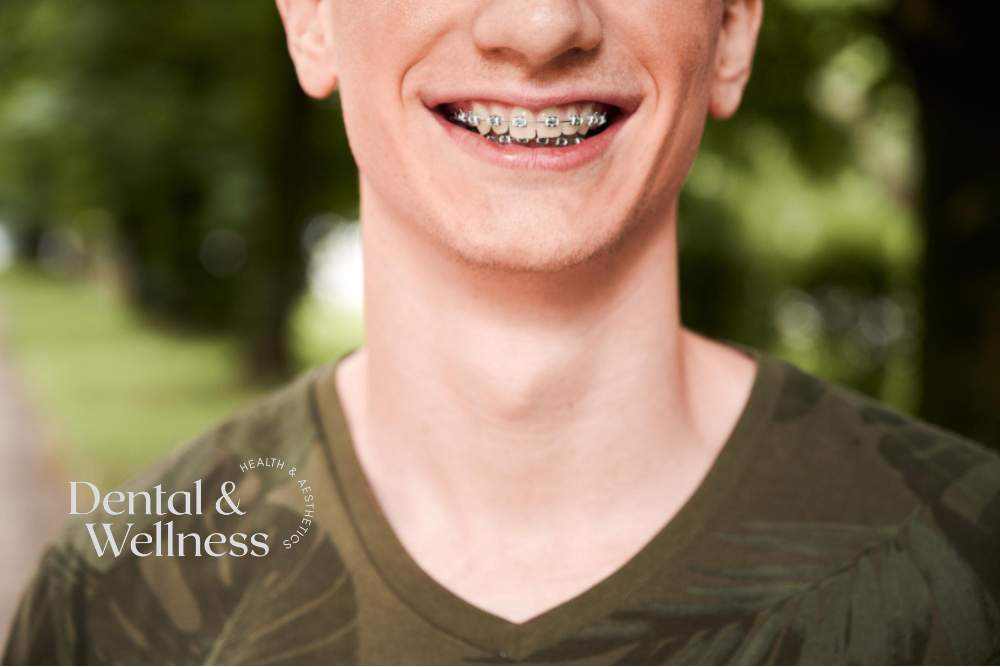 Adult dental braces