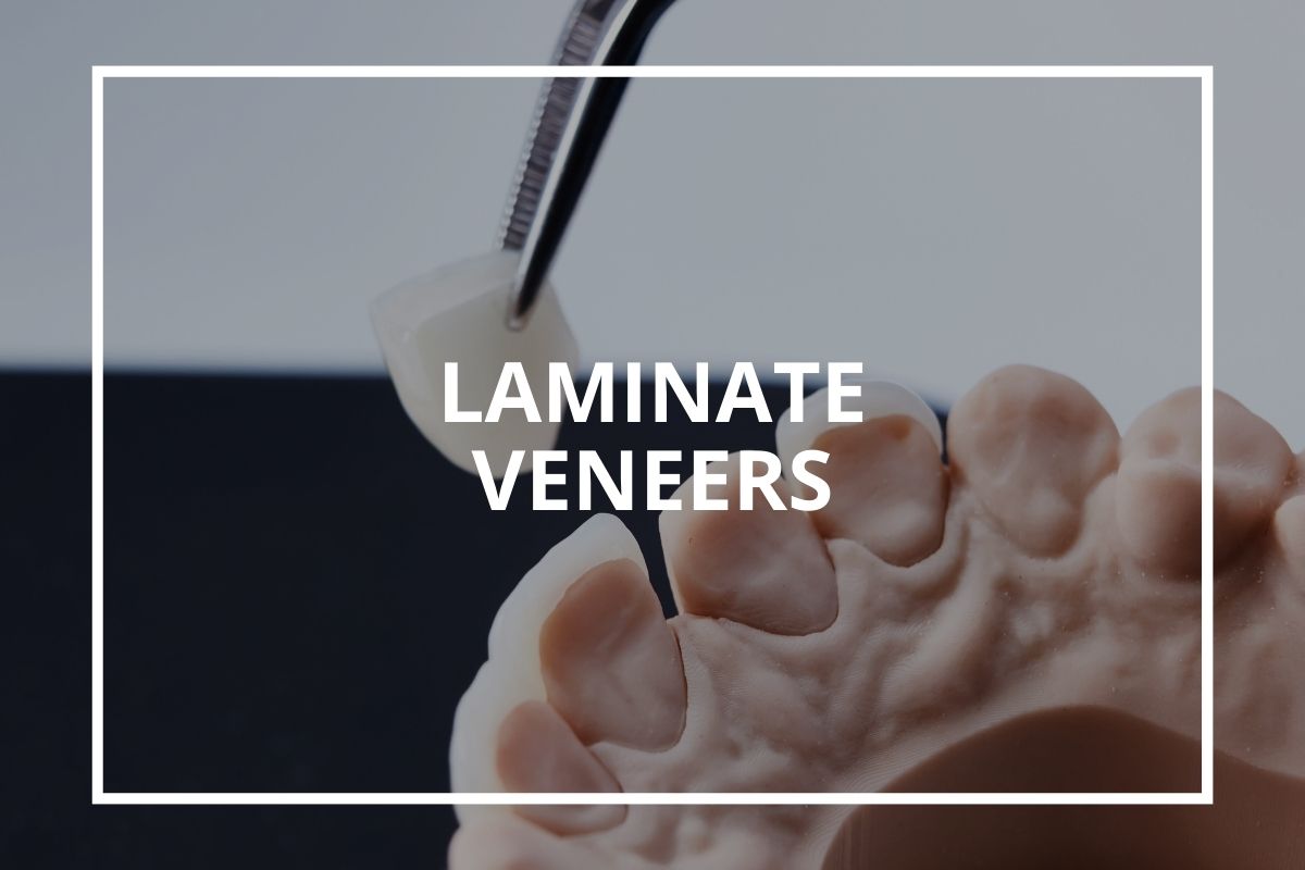 Laminate dental veneers