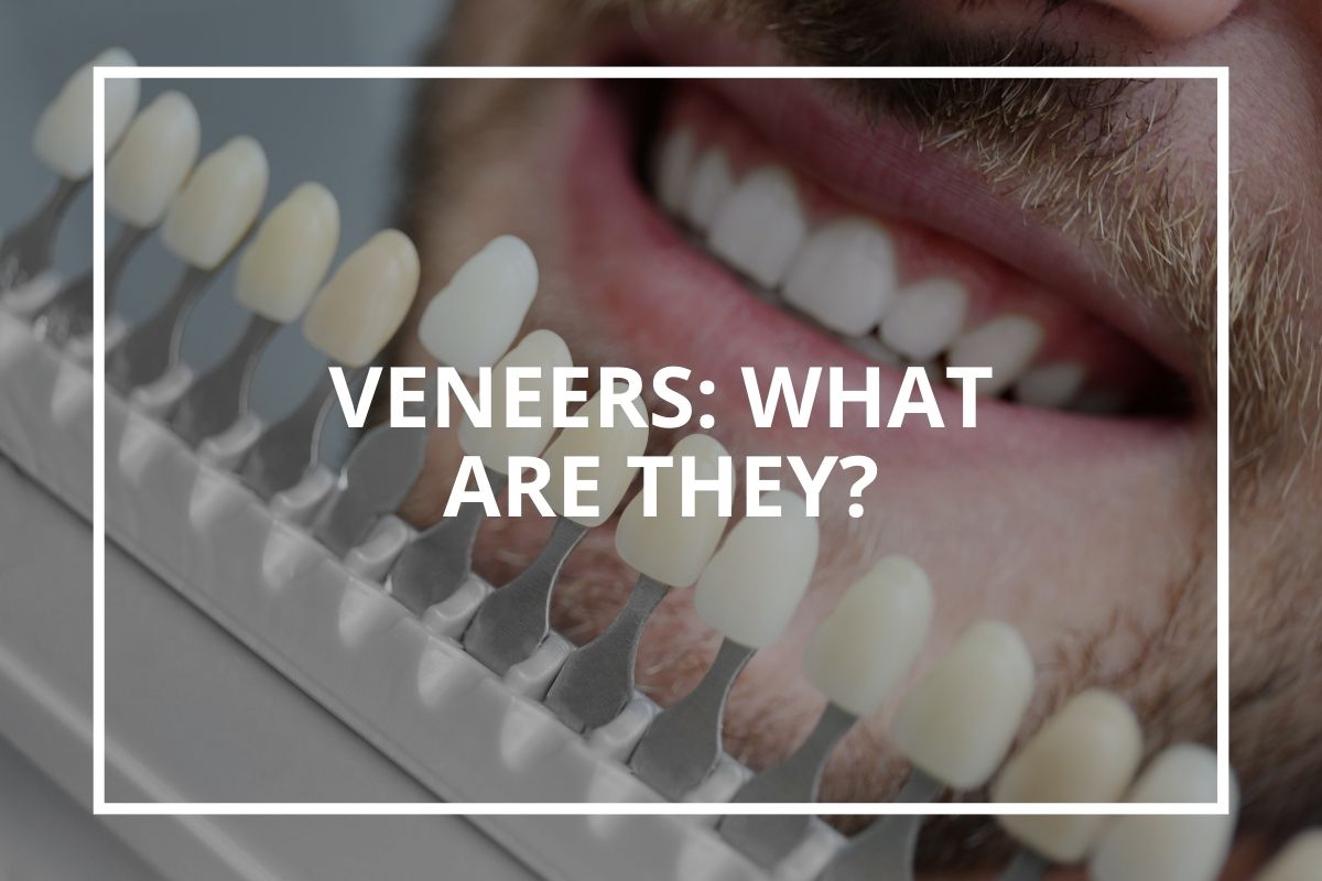 Dental veneers