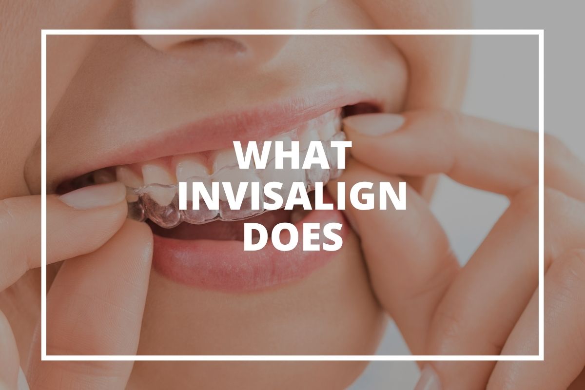 Invisalign aligner on teeth
