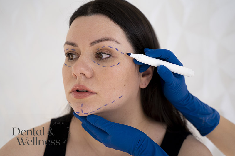 Baby Botox anti-wrinkle treatment