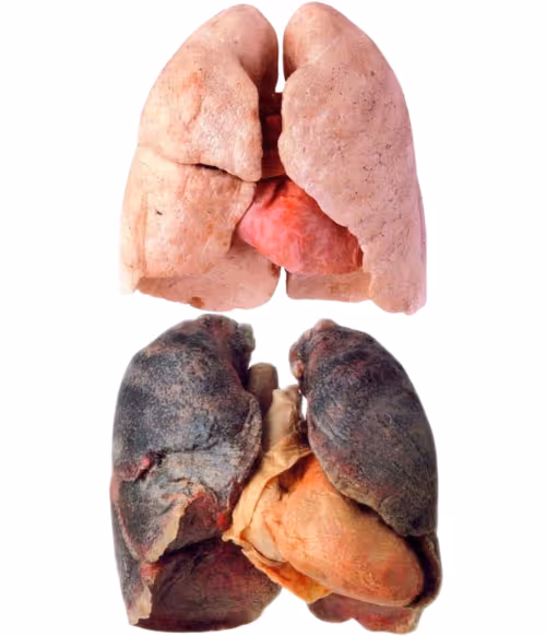 Comparison of healthy lungs and diseased lungs showing progressive degeneration caused by COPD.