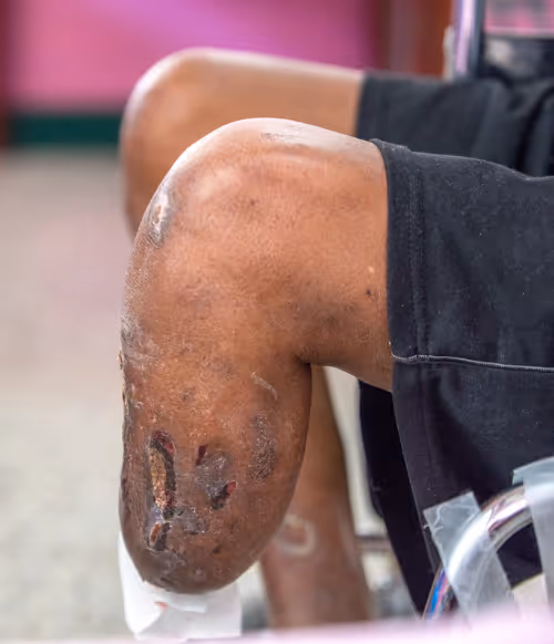 Close-up of a leg with diabetic ulcers showing chronic non-healing wounds.”