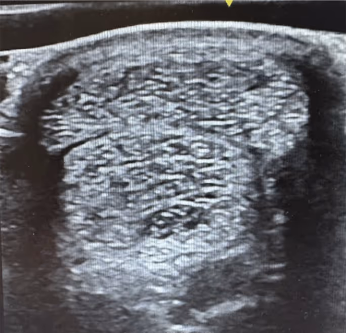 Ultrasound scan one month post-treatment, showing improved tissue condition after SMS cell therapy.