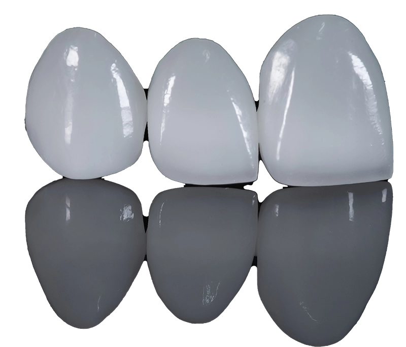 3D-Printed Veneers