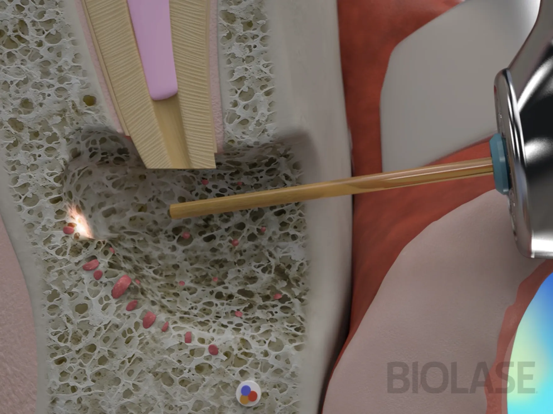 Apicoectomy