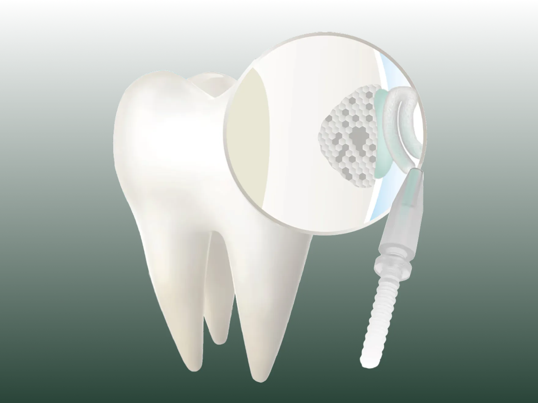 How Curodont™ Drill-Free Cavity Treatment works in Oldsmar, FL