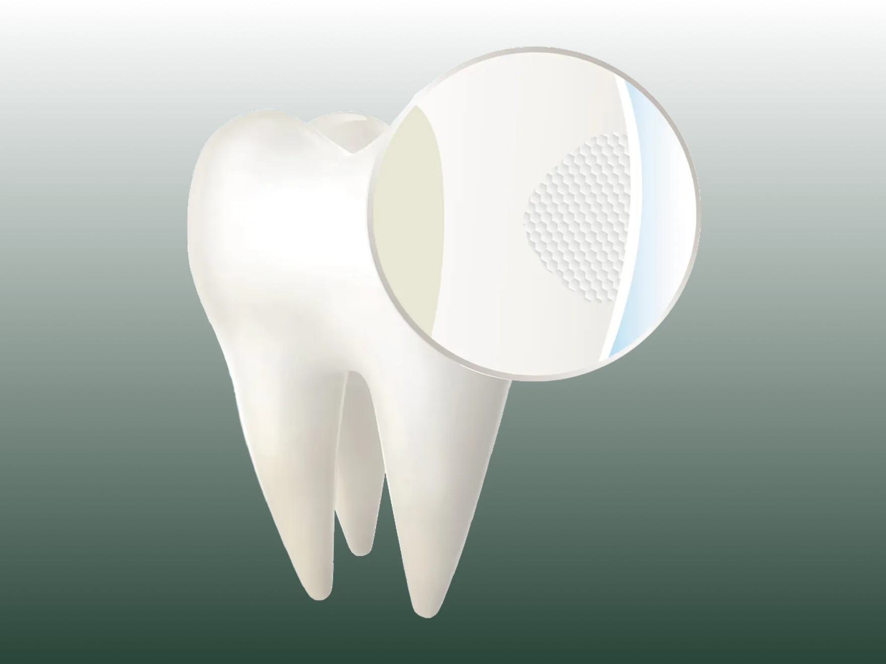 Curodont™ Drill-Free Cavity Treatment Results in Oldsmar, FL