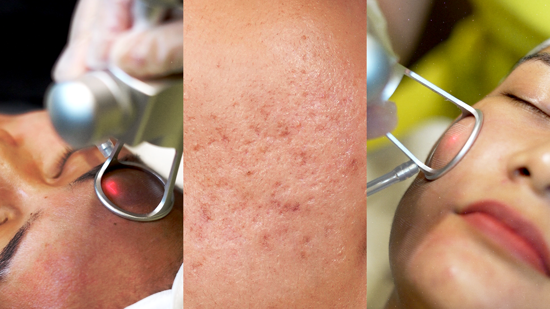 This Isn’t Your Usual CO2 Laser: Remedy’s New Acne Scar Treatment Does More