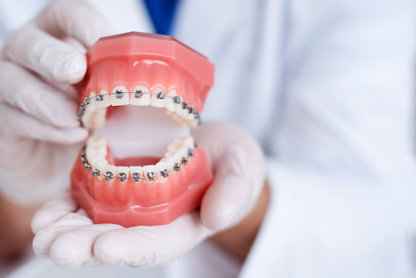 Damon Self Ligating Braces