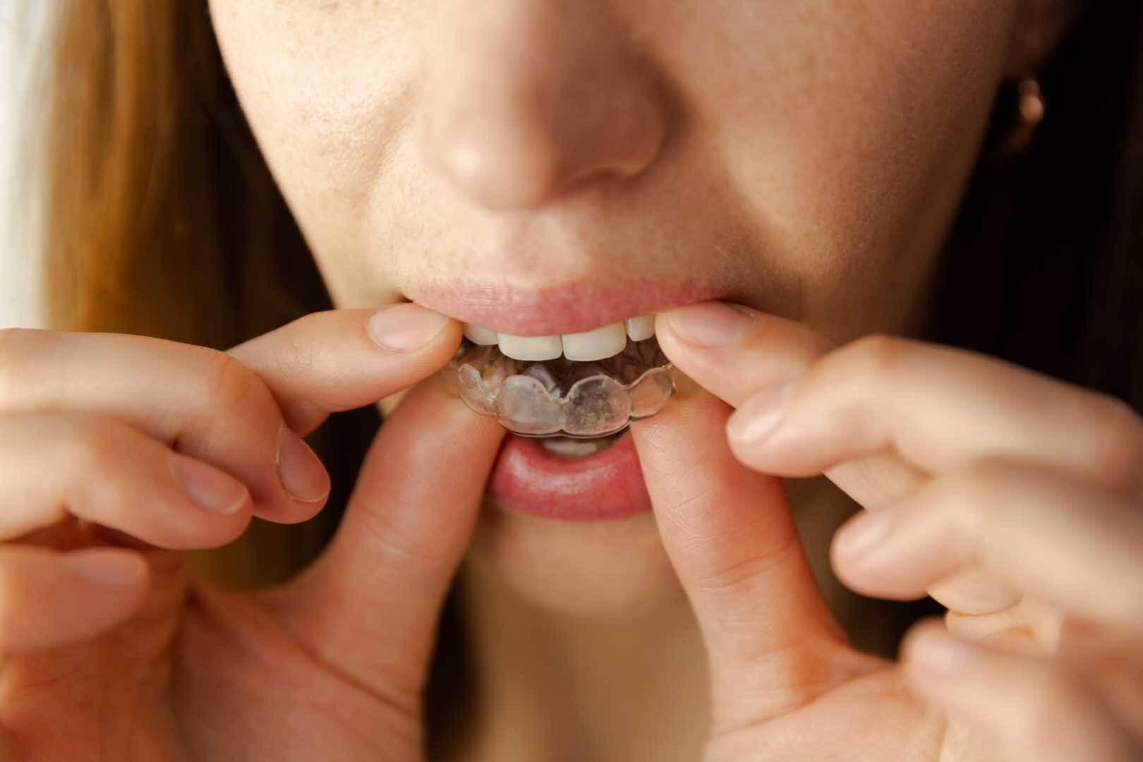 Occlusal & Sports Guards