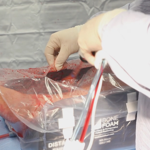 Irrigation and Debridement problem state