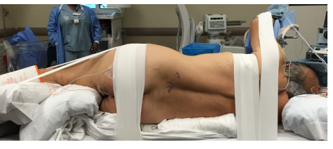 Lateral Lumbar Positioning problem state