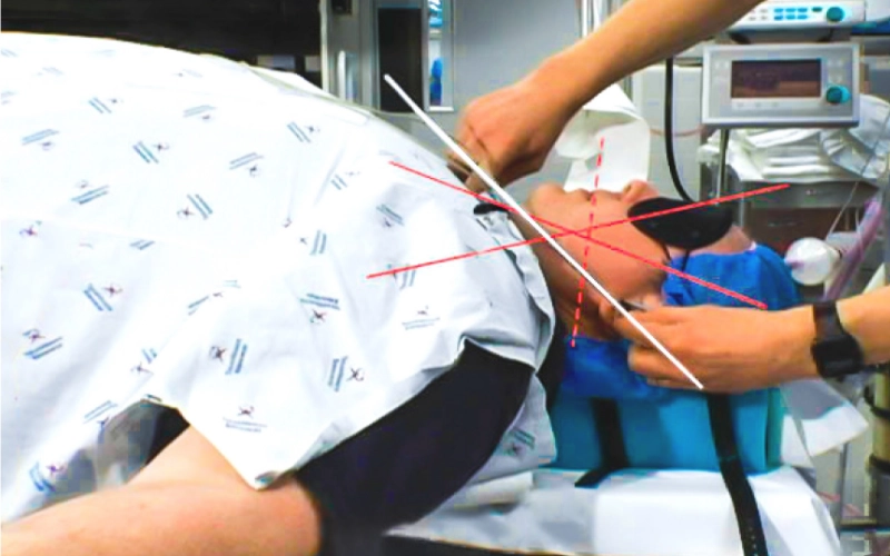 Bariatric Airway Challenges