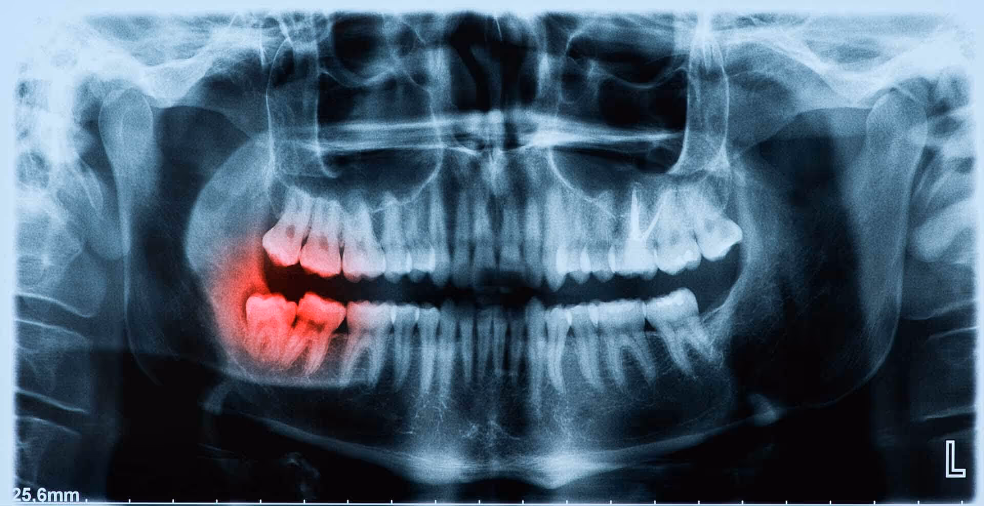 Wisdom Teeth Removal