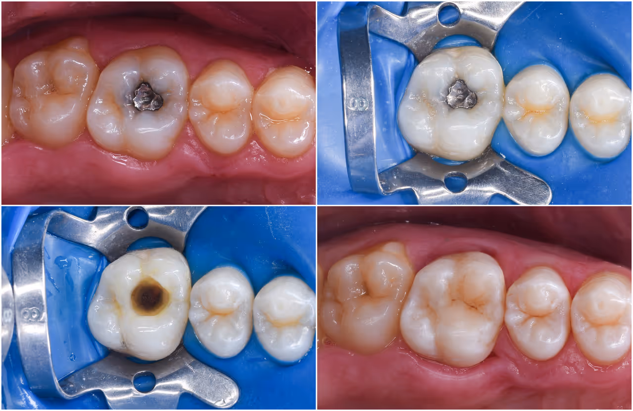 Safe Amalgam Removal