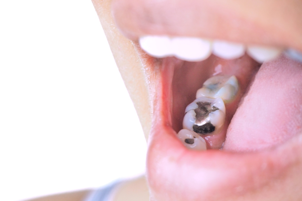 Safe Amalgam Removal