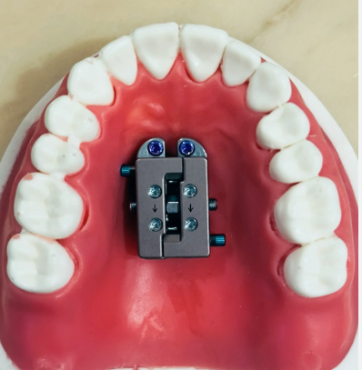 Facegenics Midface Expander (FME)