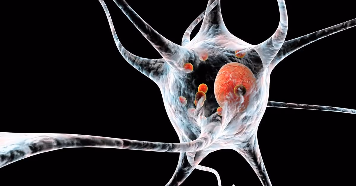 Parkinsons disease nerve cells, illustration