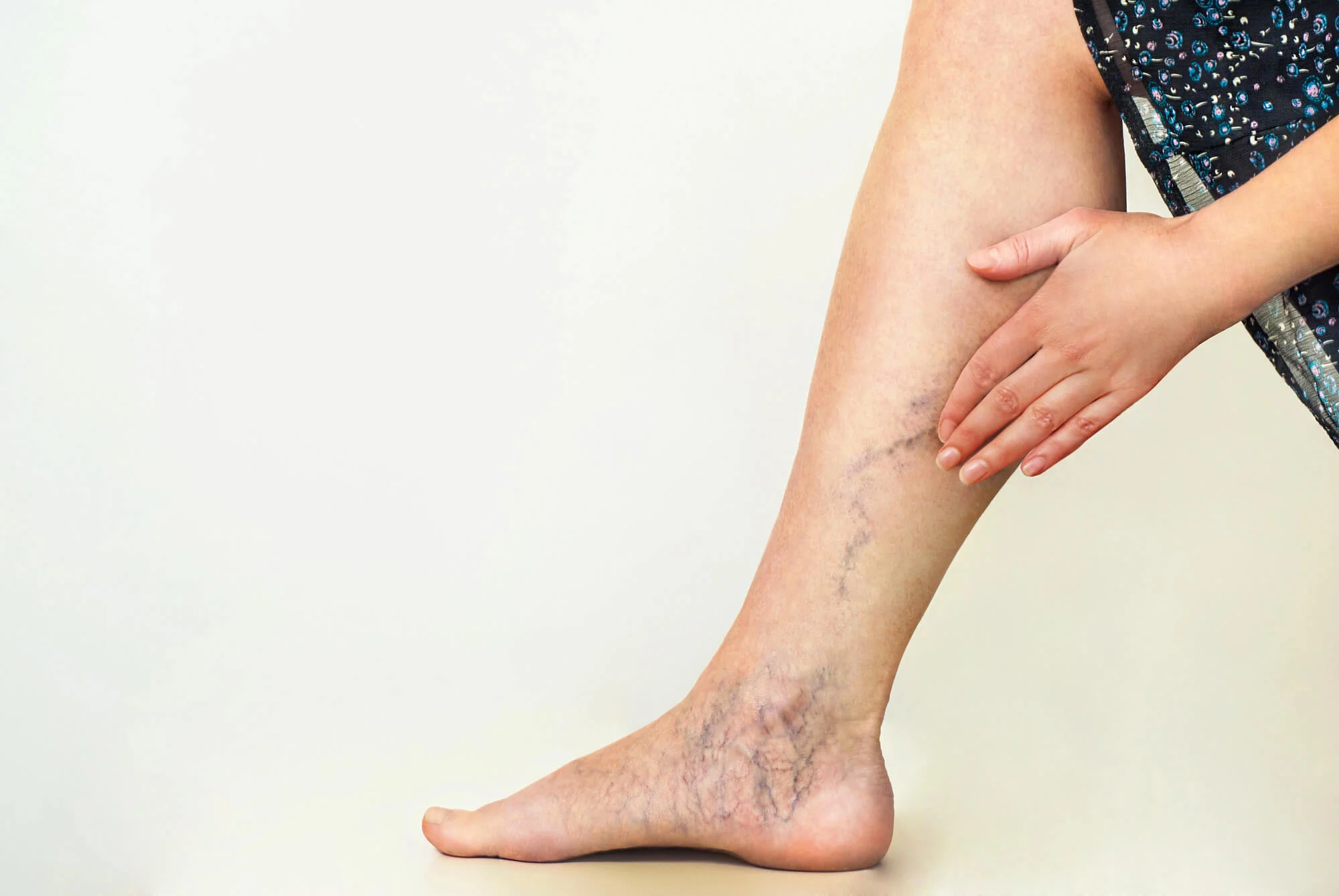 woman with varicose veins needing Compression Garments