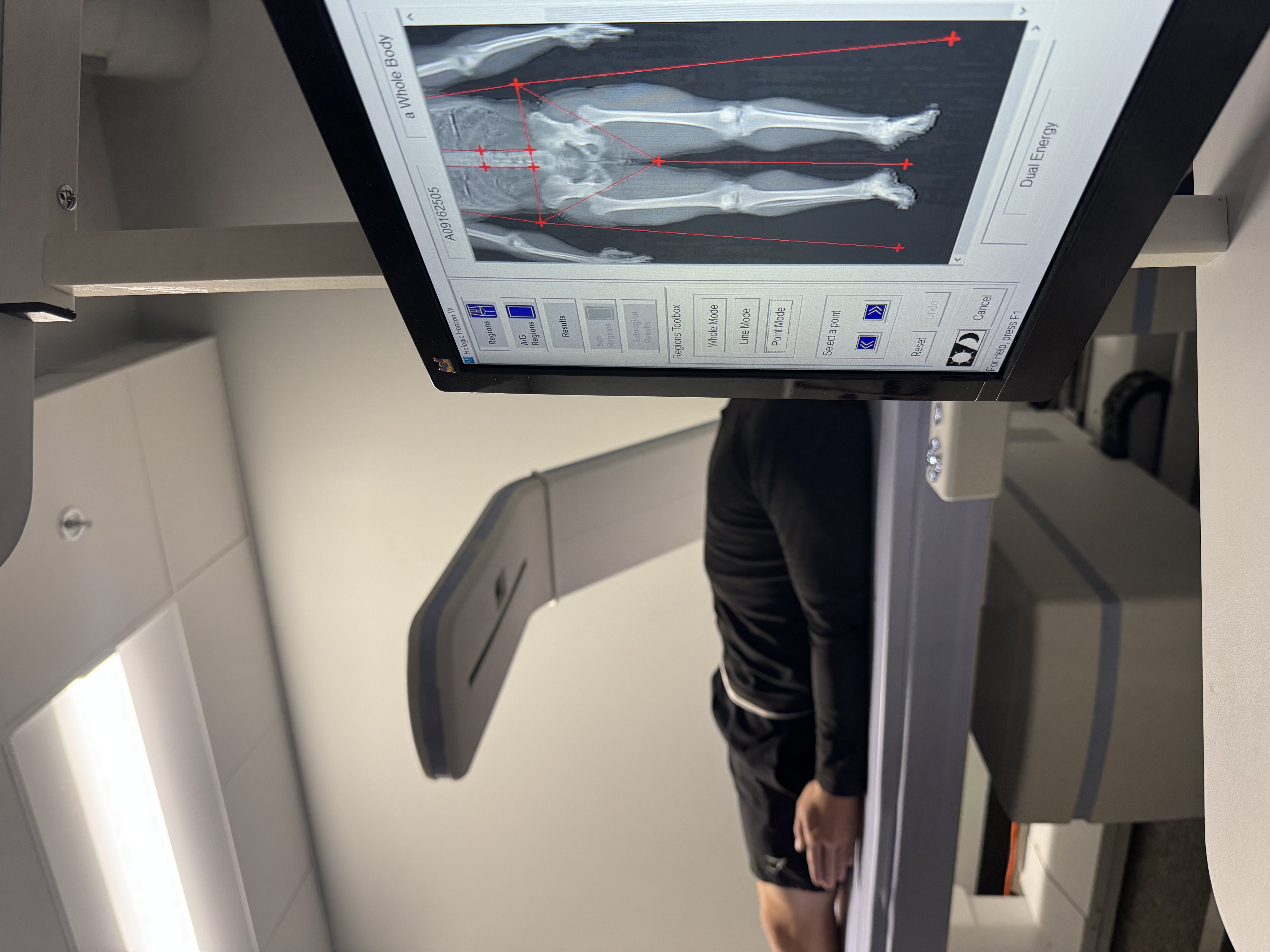DEXA Scan