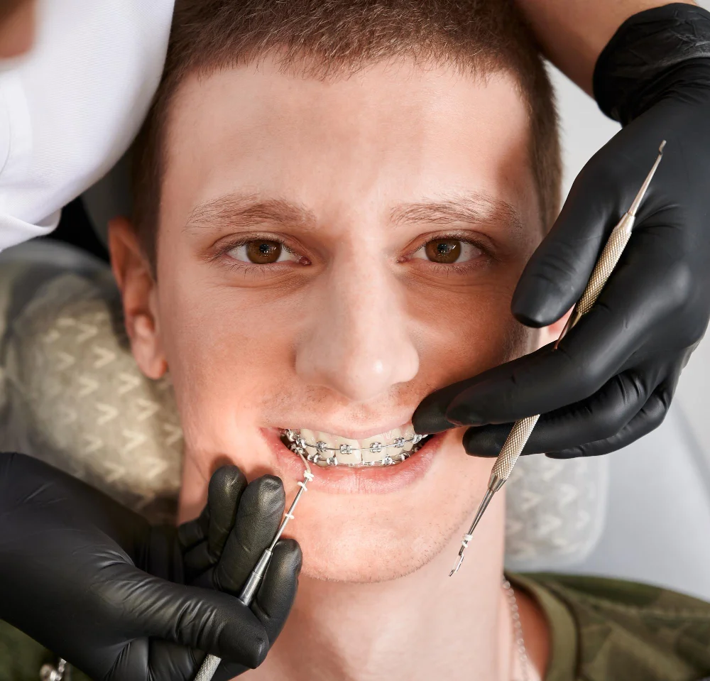 Should I Get Braces? A Houston Parent's Guide to Straightening Teeth