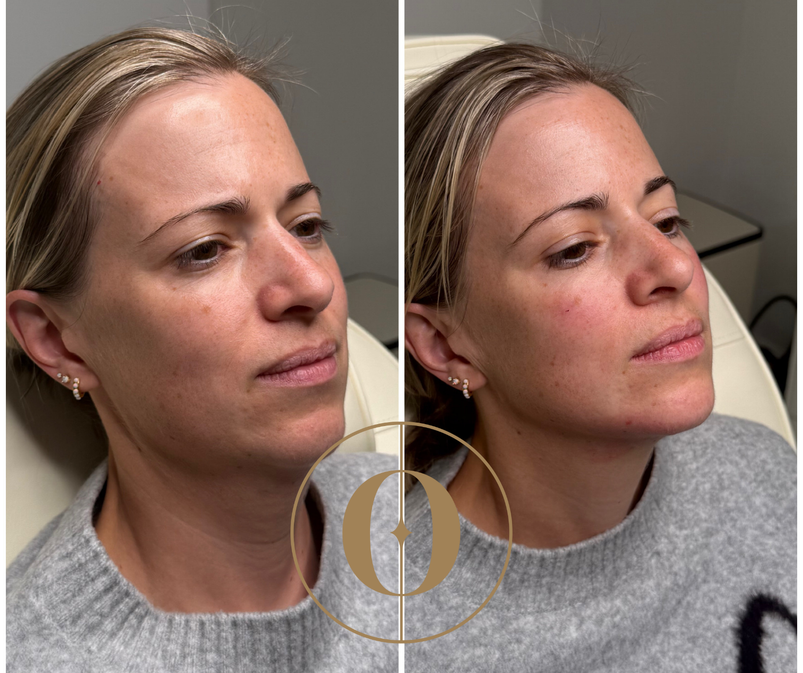 Get Your Skin Wedding-Ready: 