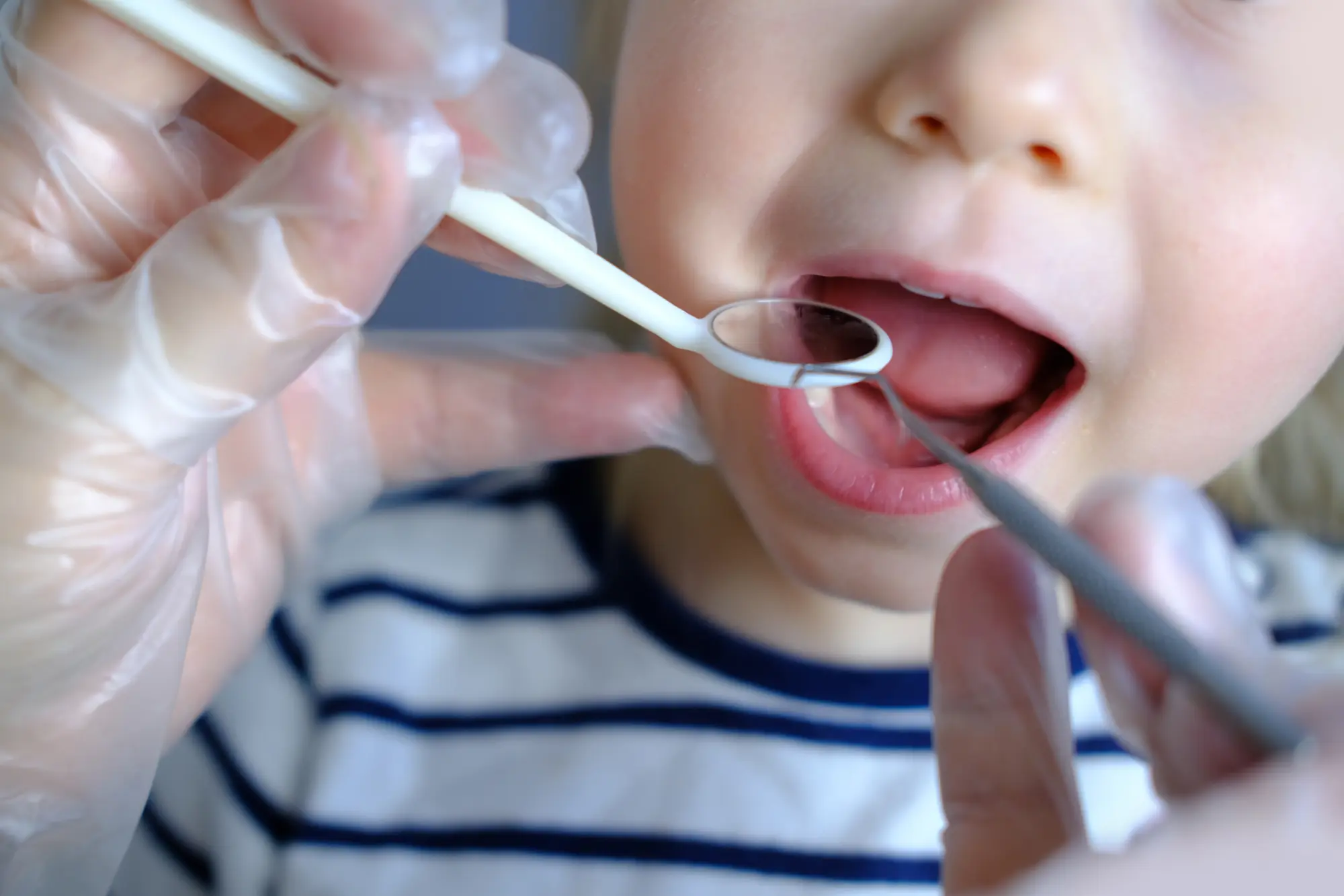 Does My Baby Need a Laser Frenectomy for a Lip or Tongue Tie?
