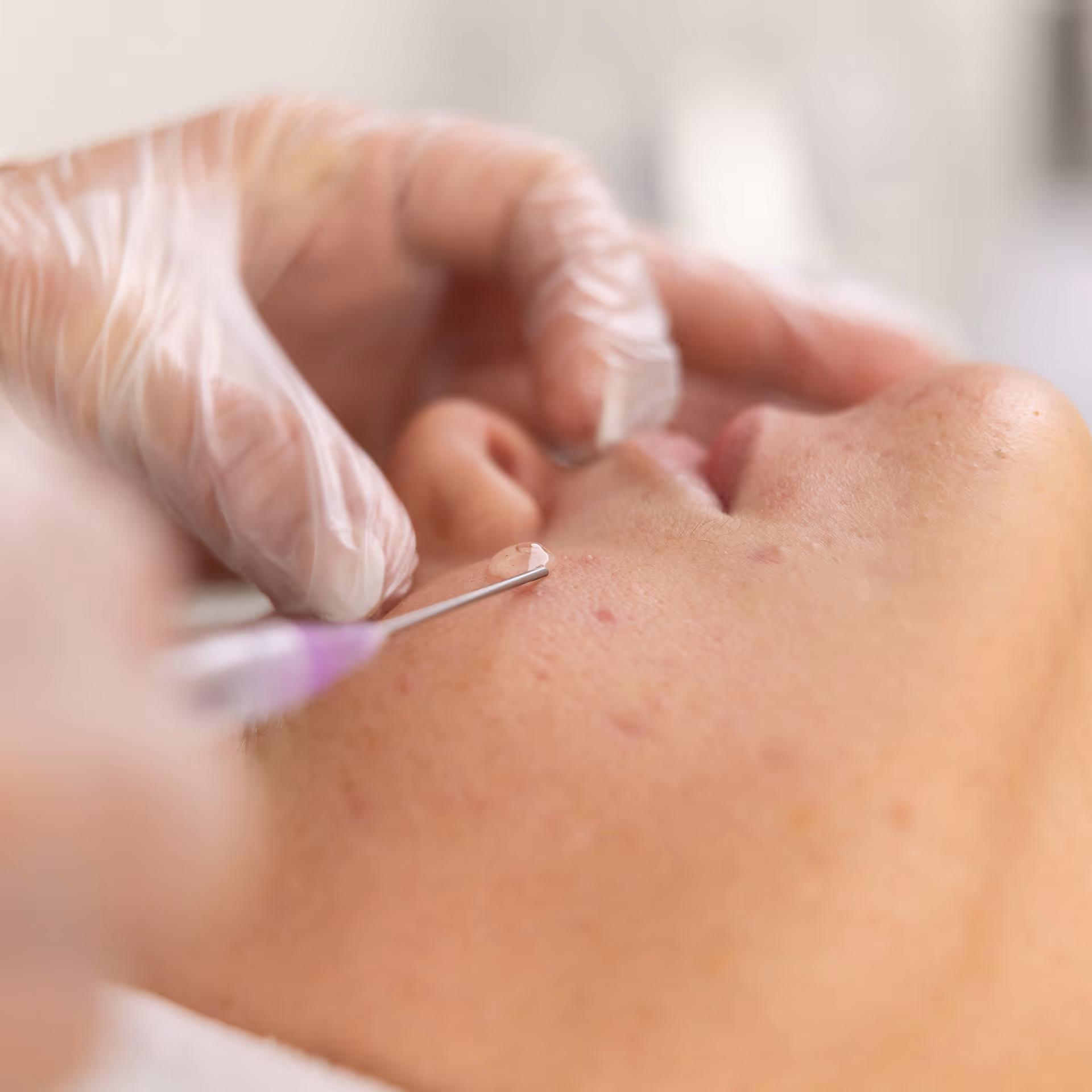 Microneedling with Exosomes Skin Booster.
